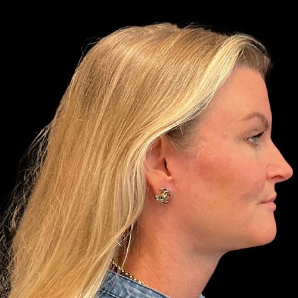 Facelift Before & After Patient #9828