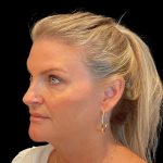 Facelift Before & After Patient #9828