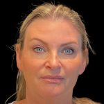 Facelift Before & After Patient #9828