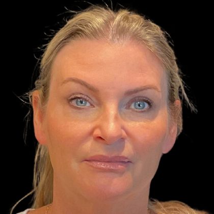 Facelift Before & After Patient #9828