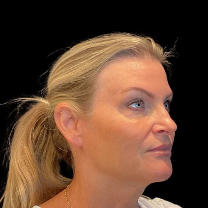 Facelift Before & After Patient #9828