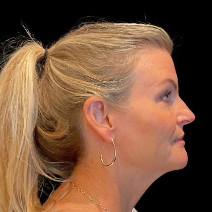 Facelift Before & After Patient #9828