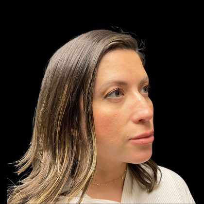 Liquid Rhinoplasty Before & After Patient #10182