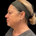 Morpheus8 Before & After Patient #10354