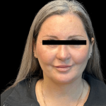 Brow Lift Before & After Patient #10440