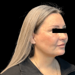 Brow Lift Before & After Patient #10440