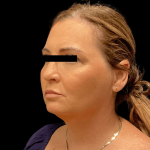 Brow Lift Before & After Patient #10440