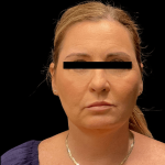 Brow Lift Before & After Patient #10440