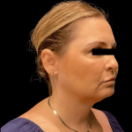 Brow Lift Before & After Patient #10440