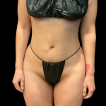 Brazilian Butt Lift Before & After Patient #10424