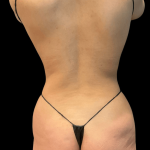 Brazilian Butt Lift Before & After Patient #10424