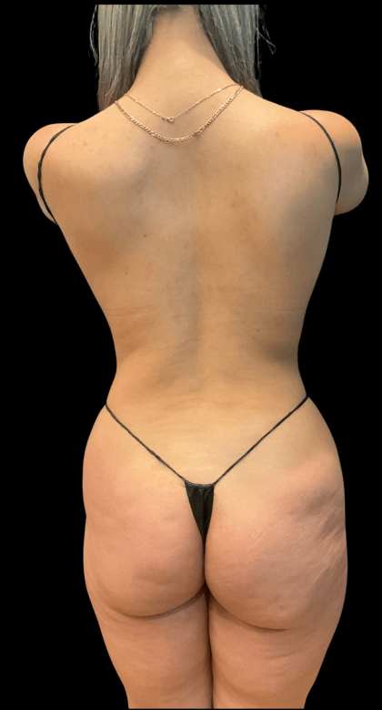 Brazilian Butt Lift Before & After Patient #10424