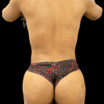 Rib Repositioning Before & After Patient #10487
