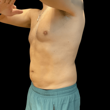 High Definition Liposuction Before & After Patient #10447