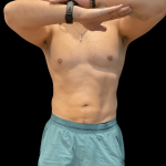 High Definition Liposuction Before & After Patient #10447