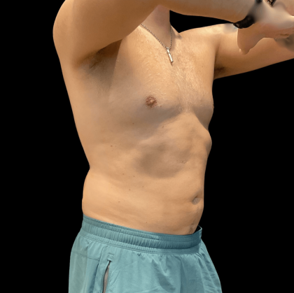 High Definition Liposuction Before & After Patient #10447