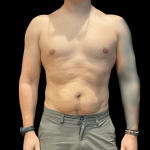 High Definition Liposuction Before & After Patient #10447