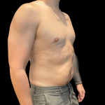 High Definition Liposuction Before & After Patient #10447