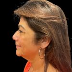 Vivace Before & After Patient #10460