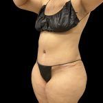 Tummy Tuck Before & After Patient #10490
