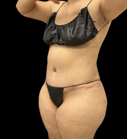Tummy Tuck Before & After Patient #10490