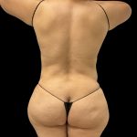 Tummy Tuck Before & After Patient #10490