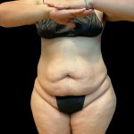 Tummy Tuck Before & After Patient #10490