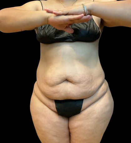 Tummy Tuck Before & After Patient #10490