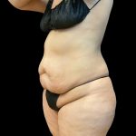 Tummy Tuck Before & After Patient #10490