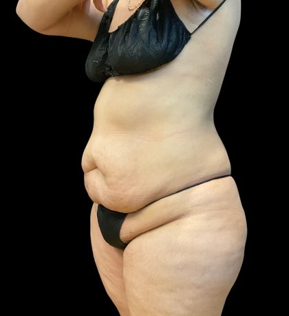Tummy Tuck Before & After Patient #10490