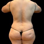 Tummy Tuck Before & After Patient #10490