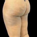Aveli (Cellulite Removal) Before & After Patient #10476