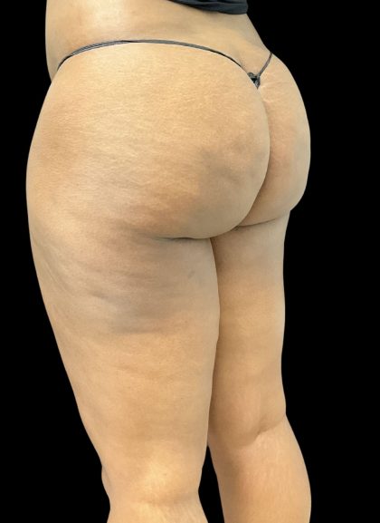 Aveli (Cellulite Removal) Before & After Patient #10476