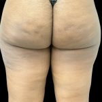 Aveli (Cellulite Removal) Before & After Patient #10476