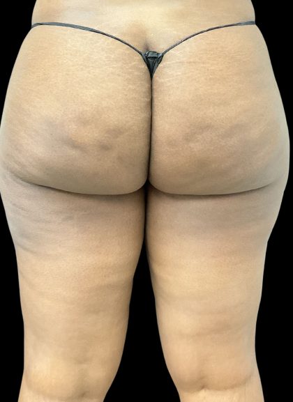Aveli (Cellulite Removal) Before & After Patient #10476