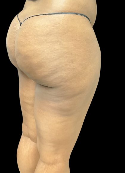 Aveli (Cellulite Removal) Before & After Patient #10476