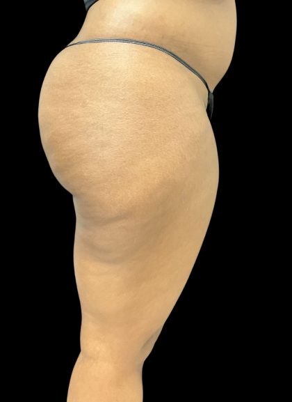 Aveli (Cellulite Removal) Before & After Patient #10476