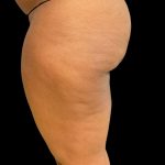 Aveli (Cellulite Removal) Before & After Patient #10476