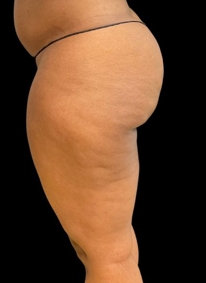 Aveli (Cellulite Removal) Before & After Patient #10476