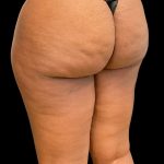 Aveli (Cellulite Removal) Before & After Patient #10476