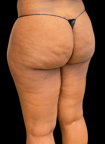 Aveli (Cellulite Removal) Before & After Patient #10476
