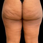 Aveli (Cellulite Removal) Before & After Patient #10476