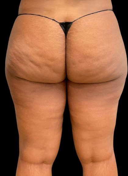 Aveli (Cellulite Removal) Before & After Patient #10476