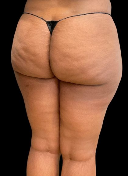 Aveli (Cellulite Removal) Before & After Patient #10476