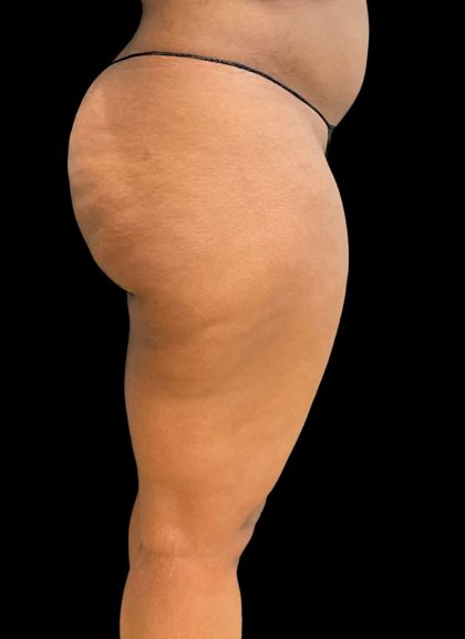 Aveli (Cellulite Removal) Before & After Patient #10476