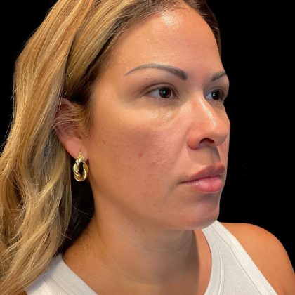 Sculptra Before & After Patient #10356