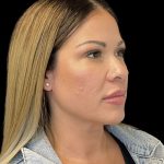 Sculptra Before & After Patient #10356