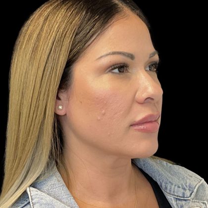 Sculptra Before & After Patient #10356
