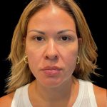 Sculptra Before & After Patient #10356