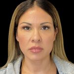 Sculptra Before & After Patient #10356